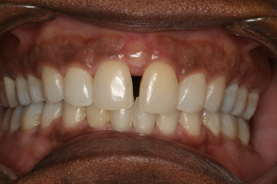 Space Closure with Invisalign - Before