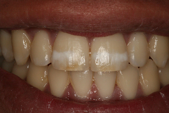 Patient missing anterior teeth